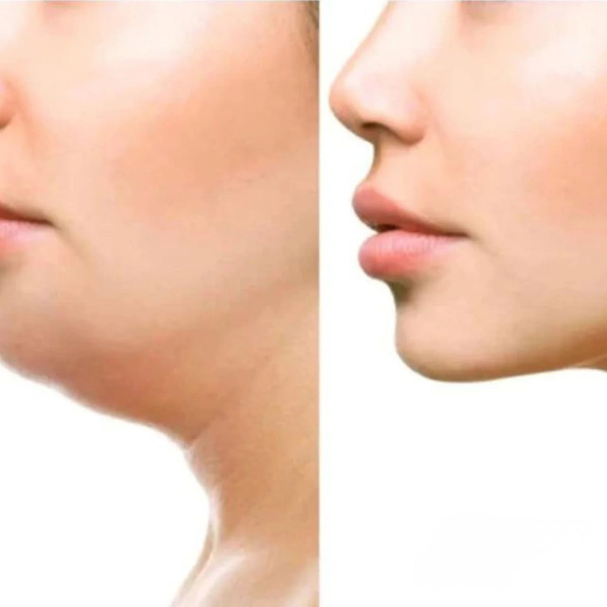 Face Lifting Device