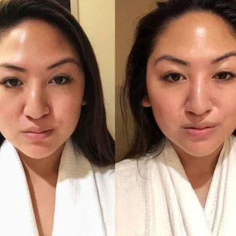 Face Lifting Device